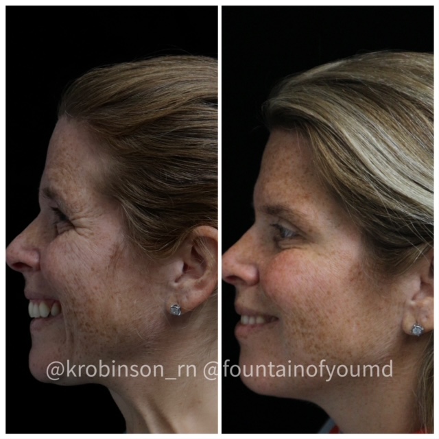 Women had a Botox Treatment on her face